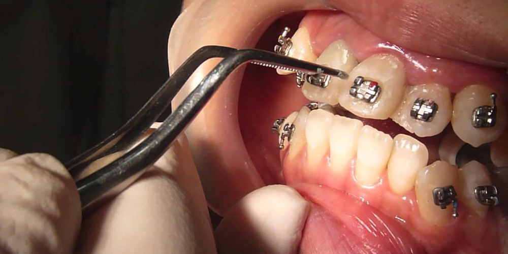 تقنية الإلصاق تقويم الأسنان