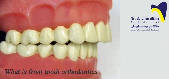 ارتودنسی دندان جلو چیست