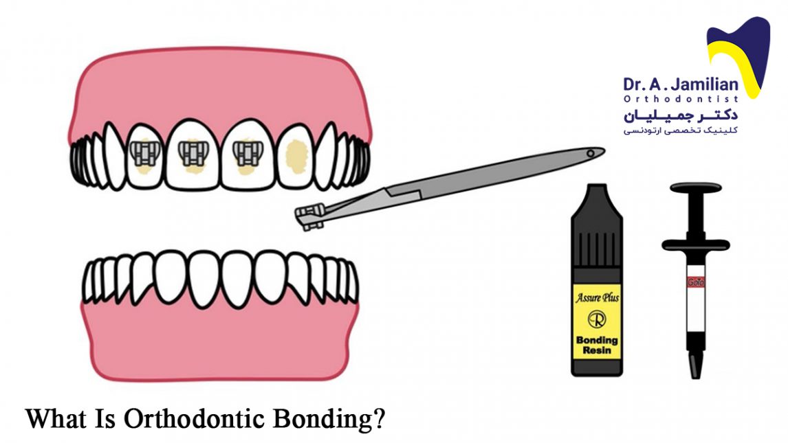What is orthodontics bonding? Dr Jamilian