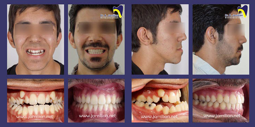 before and after of orthosurgery treatment