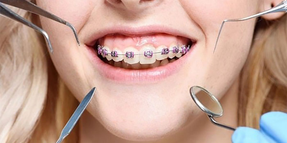 أسنان الأنثى مع تقويم الأسنان الفكي