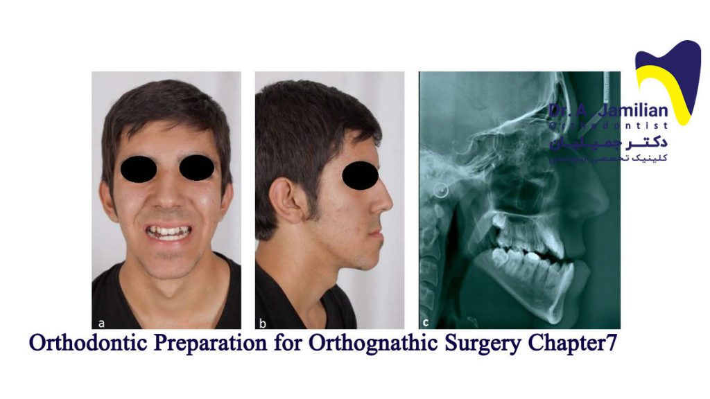 Orthodontic Preparation for Orthognathic Surgery Chapter7 Dr Jamilian