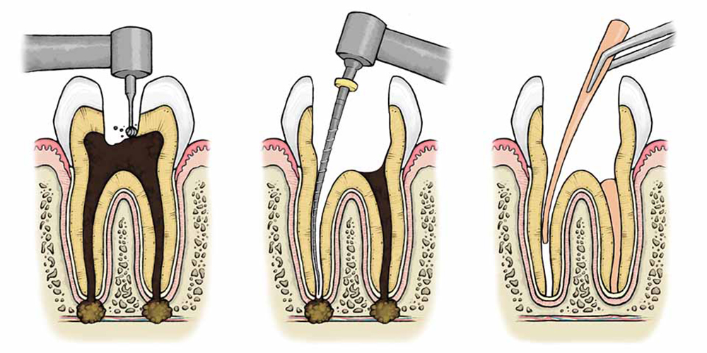 steps to remove the tooth nerve and fill the roots