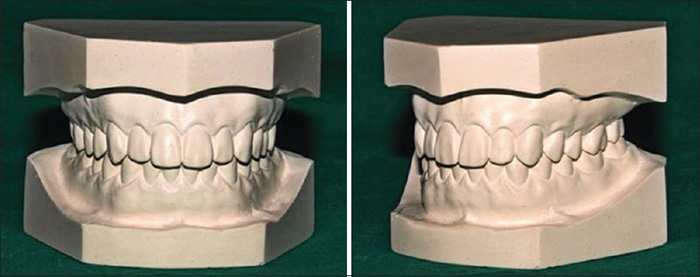پایان اصلاح قالب دندانی