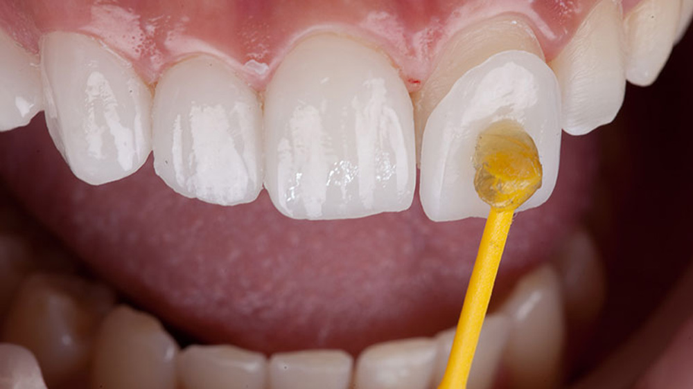 patient is applying dental laminate for smile