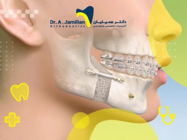 نمای جانبی فک پس از جراحی بیرون زدگی دو فک