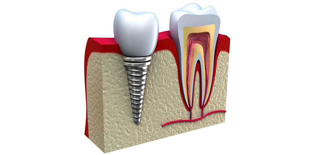 سلول های بنیادی دندان و ایمپلنت