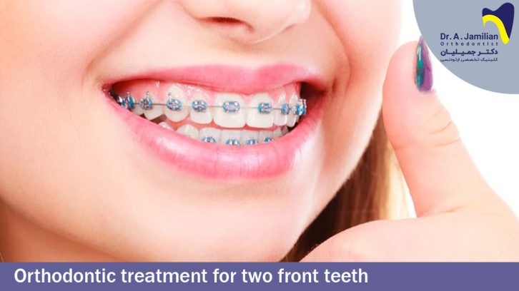 Orthodontic treatment for two front teeth - Dr Jamilian