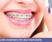 a girl how has fixed orthodontic appliances