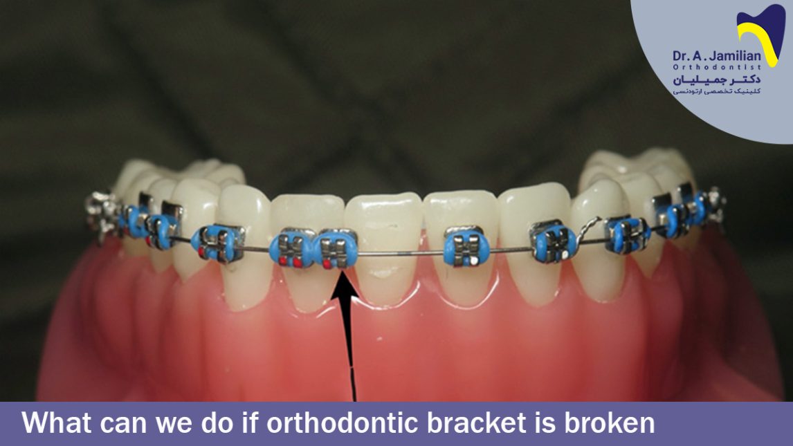 What Can We Do If Orthodontic Bracket Is Broken? Dr Jamilian