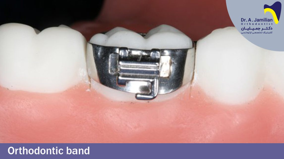 Orthodontic Band - Dr Jamilian