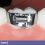 tooth with orthodontic band