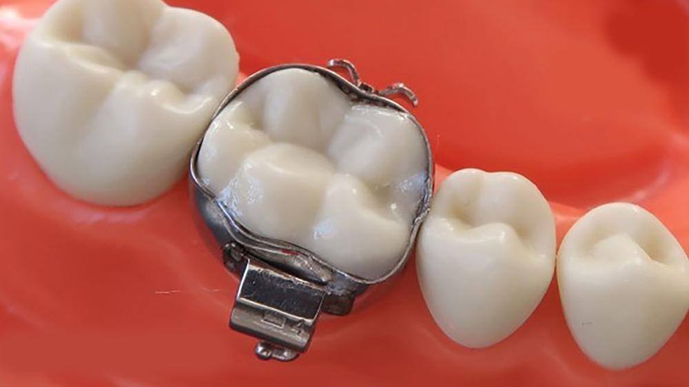 tooth with orthodontics band