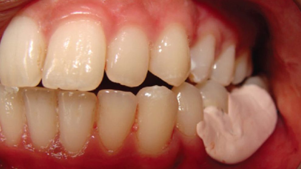 What Can We Do If Tooth Dressing is Damaged? Dr Jamilian