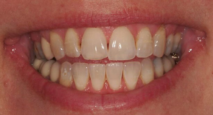 علت سیاه شدن بین دو دندان