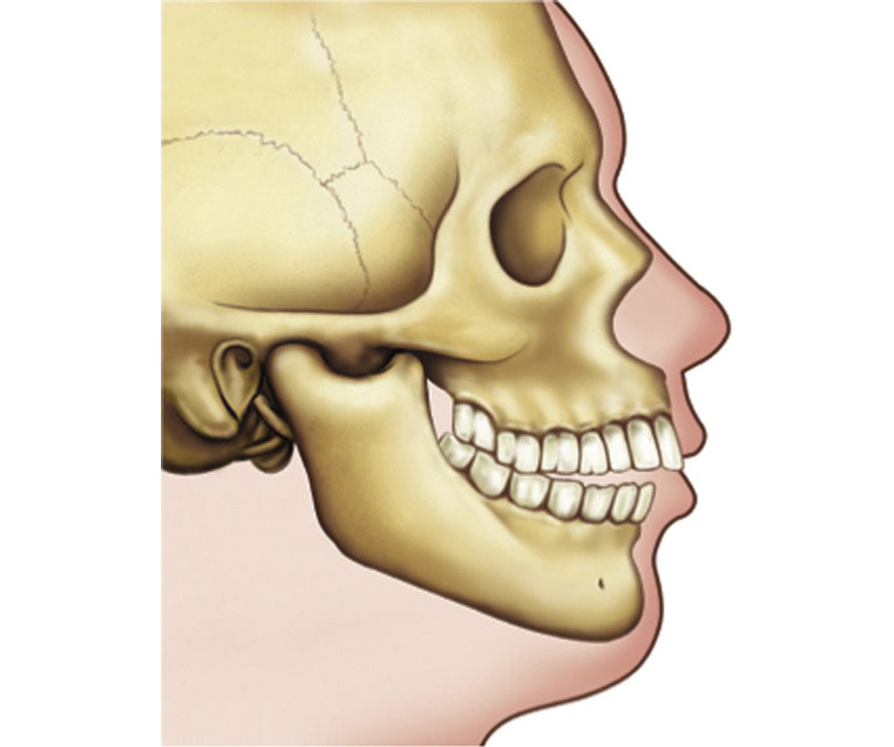 عقب ماندگی فک پایین