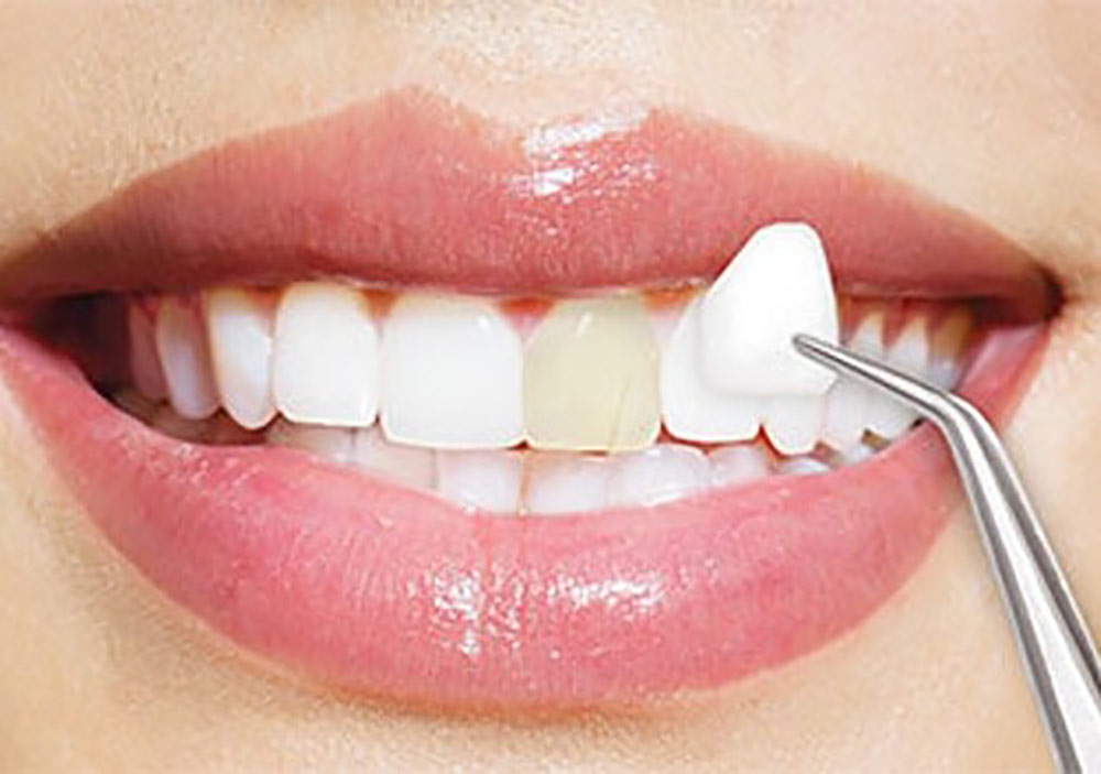 کامپوزیت برای مرتب کردن دندانها