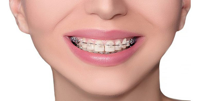 Deep bite orthodontics treatment