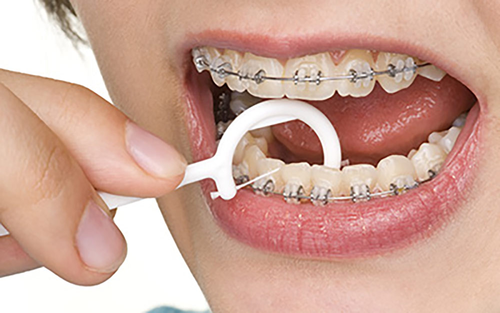 دندان های سالم حین ارتودنسی