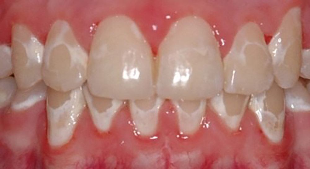 المضاعفات التقويمية لكتلة الأسنان