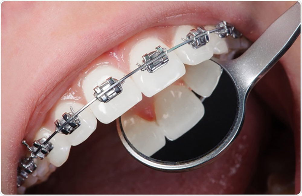 preventing orthodontic complications