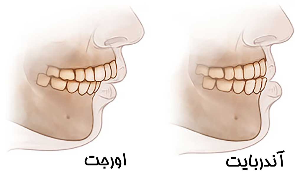 آندربایت اورجت دندانی