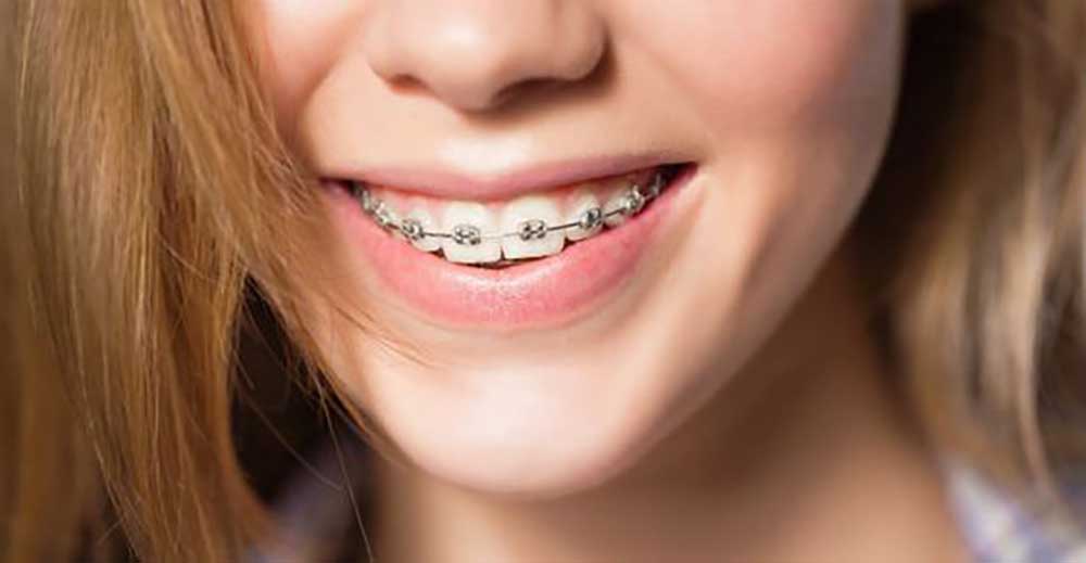 a girl with fixed metal orthodontics