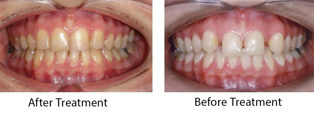 قبل وبعد علاج تقويم الاسنان