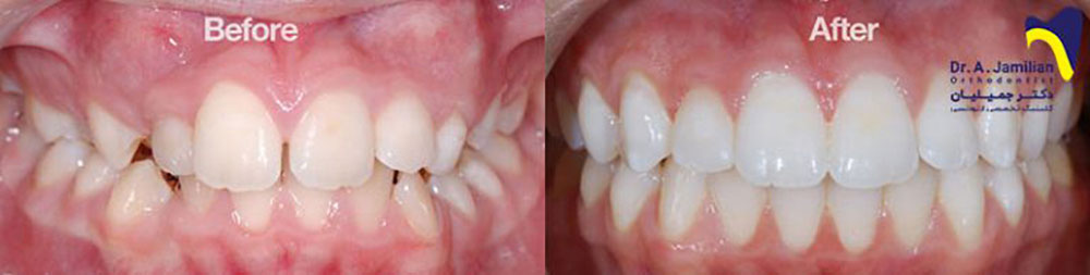 before and after of crowding tooth treatment