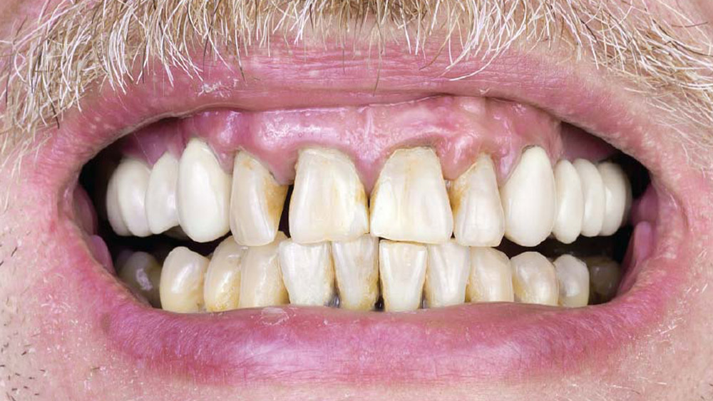نمای نزدیک از دندان و لثه ی مردی که دارای عفونت لثه ناشی از سیگار کشیدن میباشد