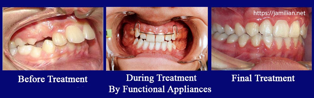 treatment-by functional r-appliance