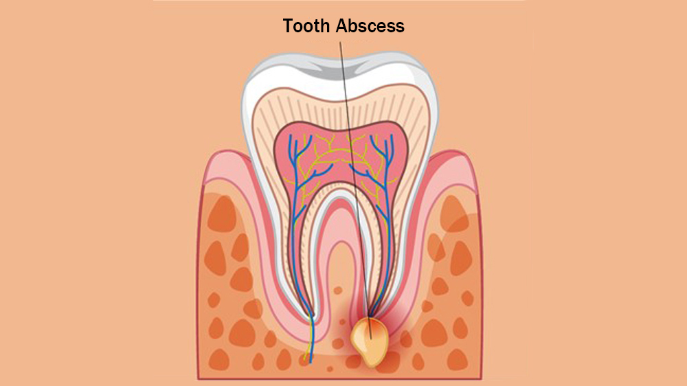 Ein Abszess im Bereich der Zahnwurzel