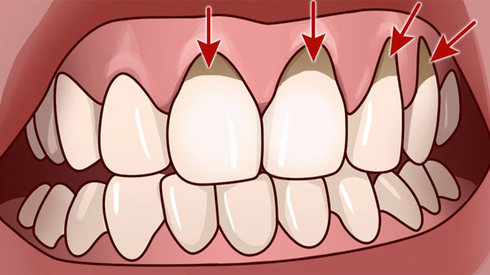 Zahn mit Zahnfleischentzündung