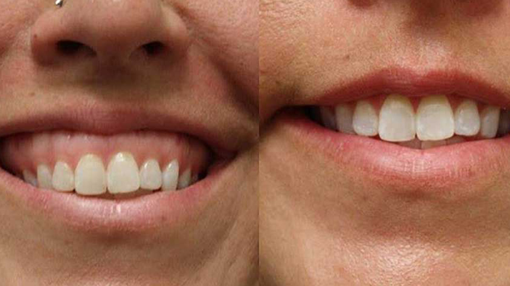 before and after of gummy smile treatment