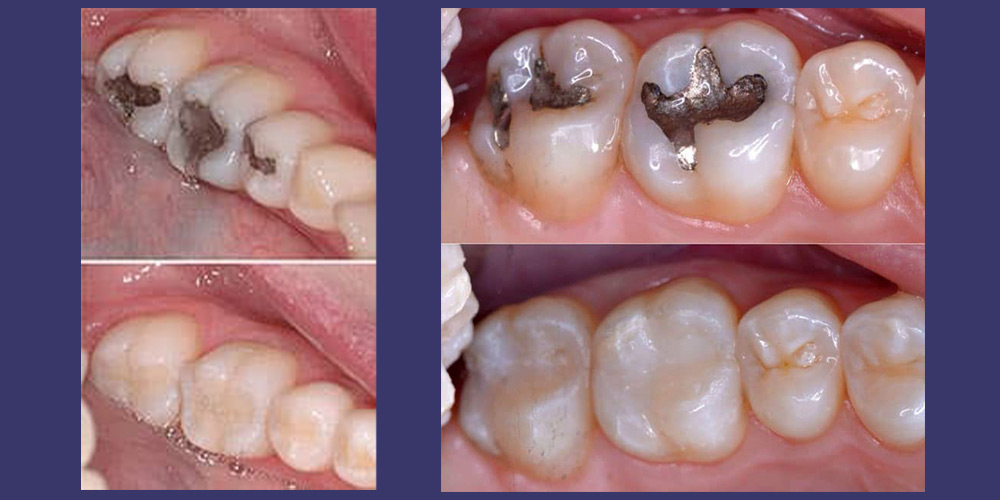 filled tooth with amalgam and composite