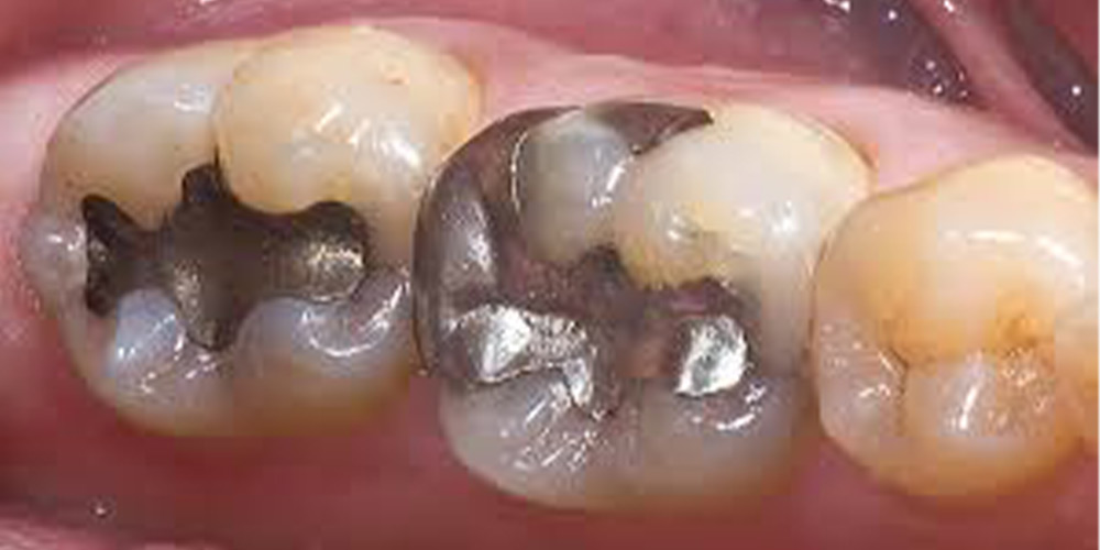 filled tooth with amalgam