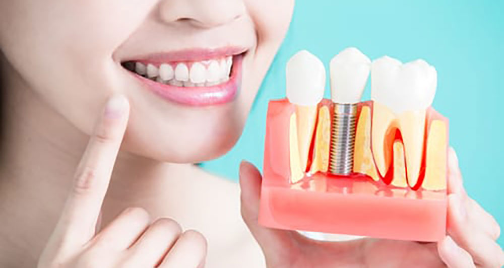 a woman showing dental implant