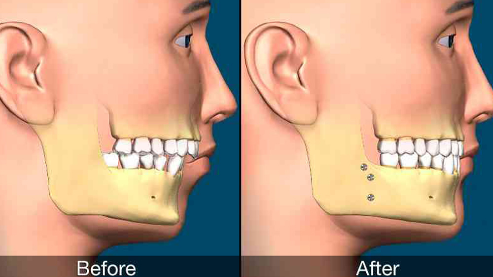before and after of chin deviation surgery