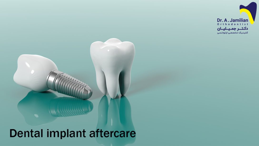 Dental implant aftercare Dr Jamilian