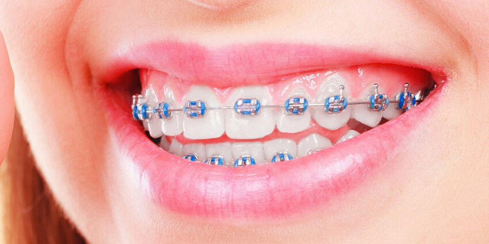 تأثير تقويم الأسنان والشكل الصحيح
