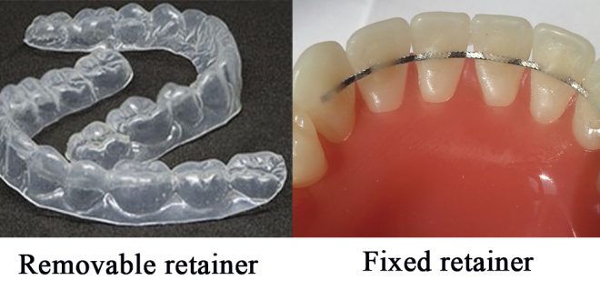 What Is A Retainer? - Dr Jamilian