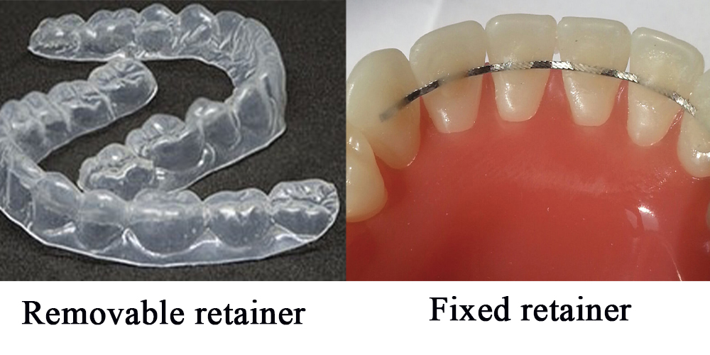 images of fixed retainer and removable retainer