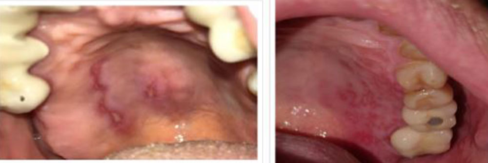 مرض مع تقرحات في الفم