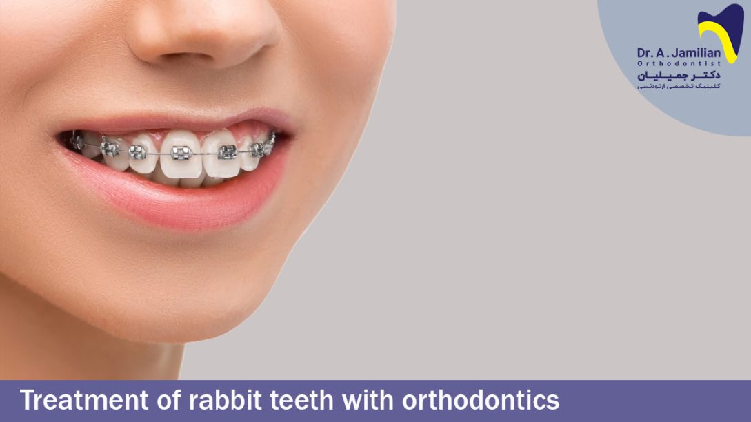 Treatment Of Rabbit Teeth With Orthodontics - Dr Jamilian