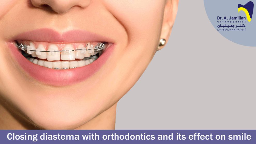 Closing Diastema With Orthodontics And It’s Effects On Smiling - Dr ...