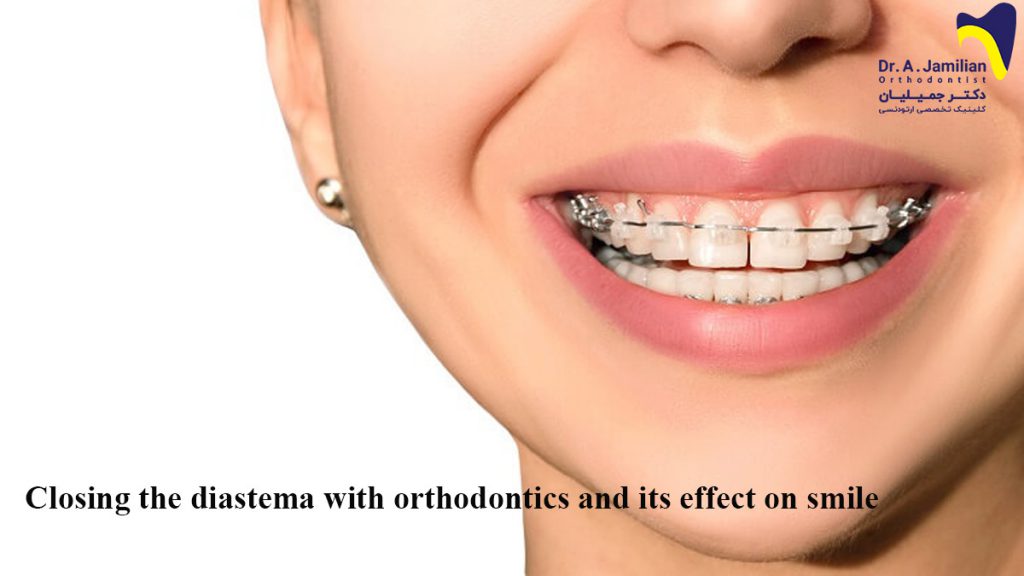 Closing diastema with orthodontics and its effect on smile - Dr Jamilian