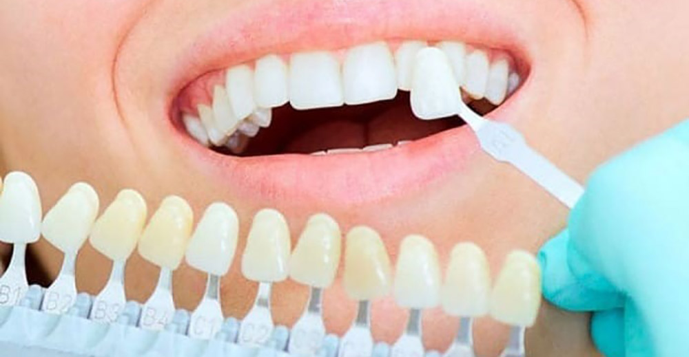 dental laminate test on patient teeth