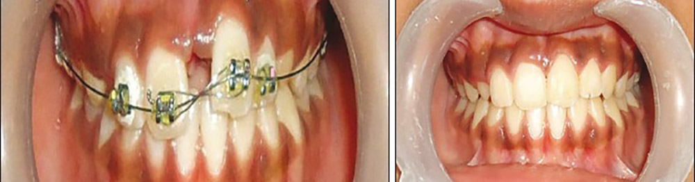before and after Image of dental diastema orthodontics treatment