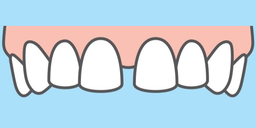 illustration of space between two teeth in upper jaw