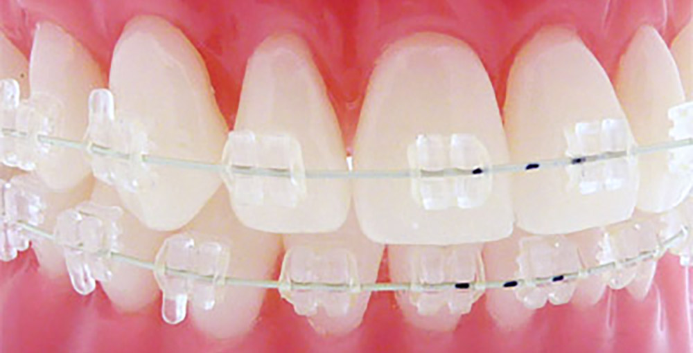 orthodontics and dental composites